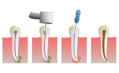 Что делать если болит зуб после удаления нерва?