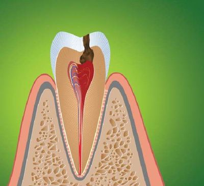 Почему удаляют нерв в зубе?