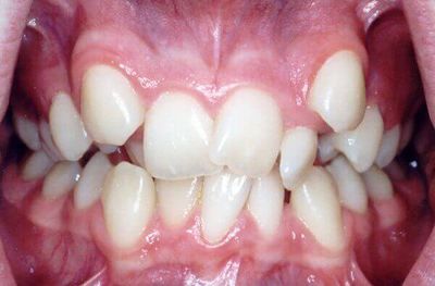 Что такое дистопия зуба?