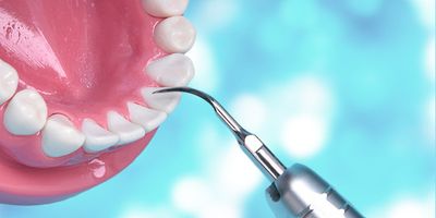 Зачем нужно удаление зубного камня?