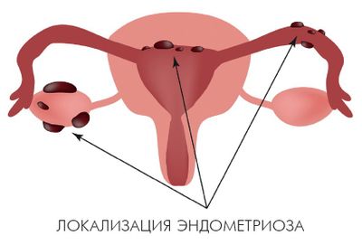 Диагностика и лечение генитального эндометриоза