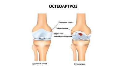Лечение остеоартроза