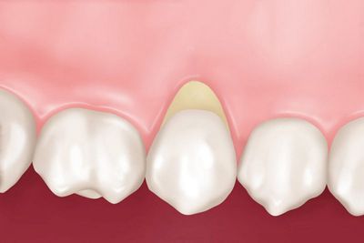 Гиперстезия зубов: причины и лечение