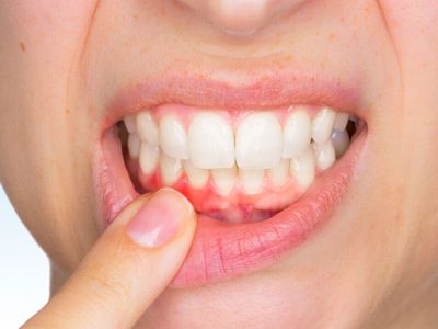 Абсцесс зубов — показания, профилактика болезни