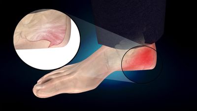 Лечение,причины, симптомы пяточной шпоры