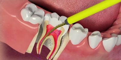 Когда нерв в зубе необходимо удалять?