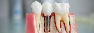 Современные материалы для изготовления зубных имплантатов