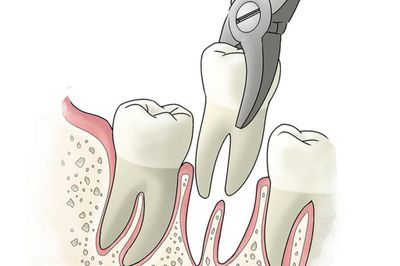 Есть шанс спасти зуб, если от него остался только корень?