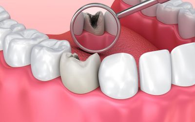 Нужно ли лечить кариес, если зуб не болит?
