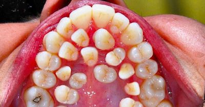 Гипердонтия у детей: лишние зубы