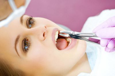 Как пережить удаление зуба и не вызвать осложнения