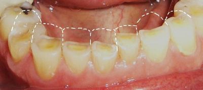 Патологическая стираемость зубов и бруксизм