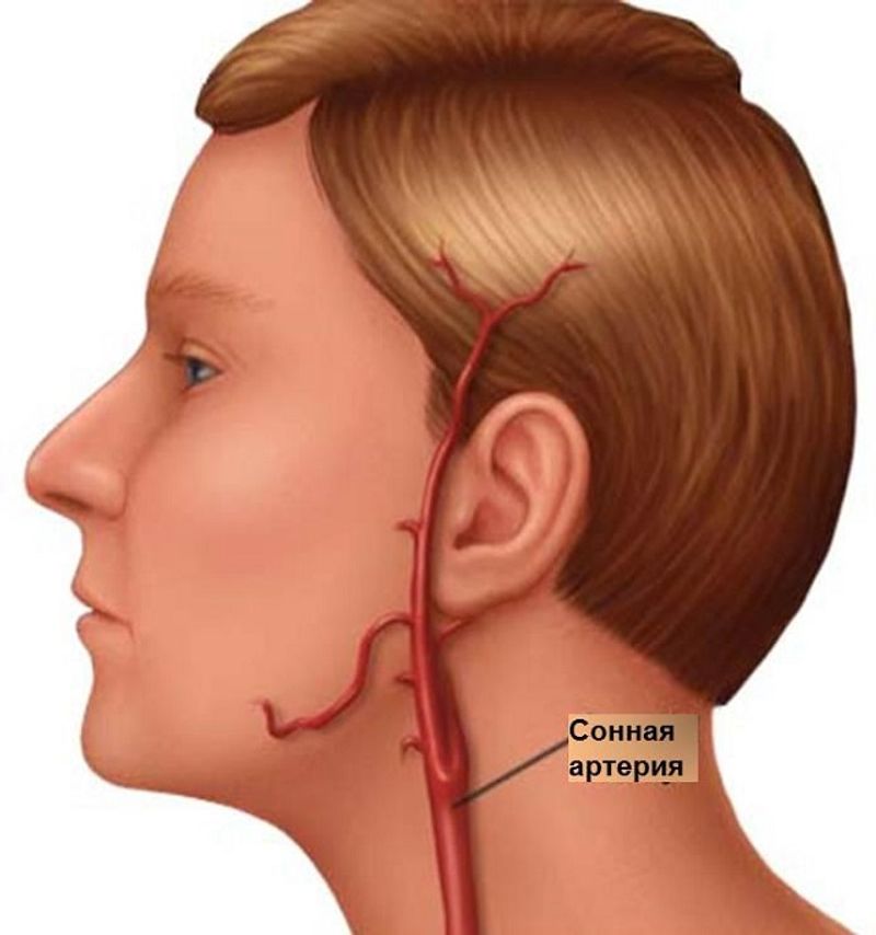 Сонные артерии на шее человека фото. Сонная артерия на шее расположение. Атеросклероз сосудов сонных артерий.